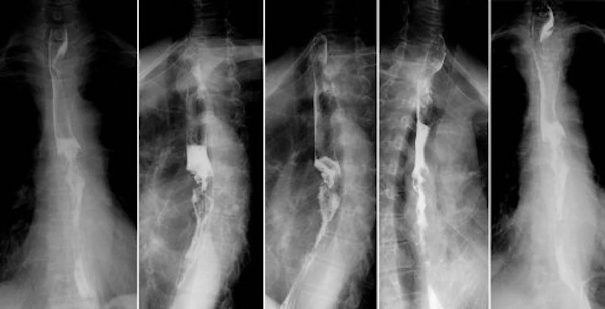 Strumenti diagnostici per il reflusso gastrico